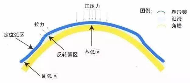 角膜塑形镜偏位范围图图片