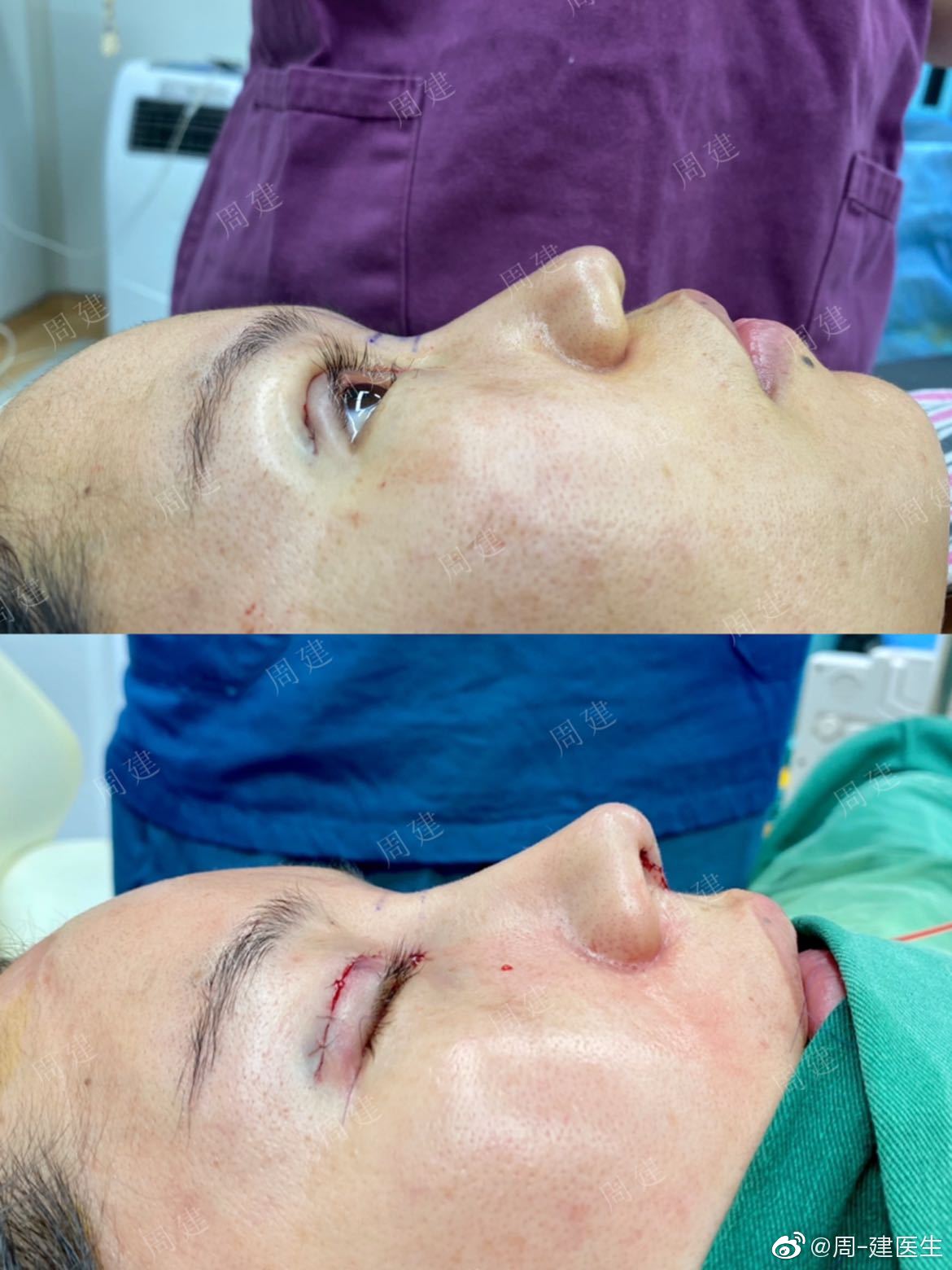 哑铃鼻基底,新术式不移位,郑州周建医生鼻整形专访