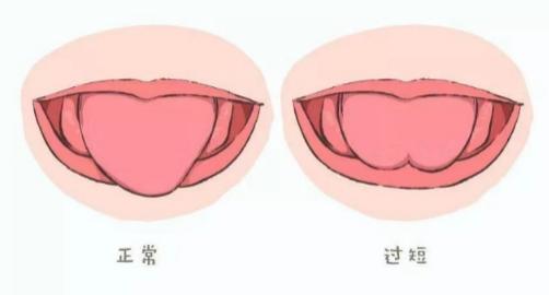 宝宝舌系带短"剪"还是"不剪?
