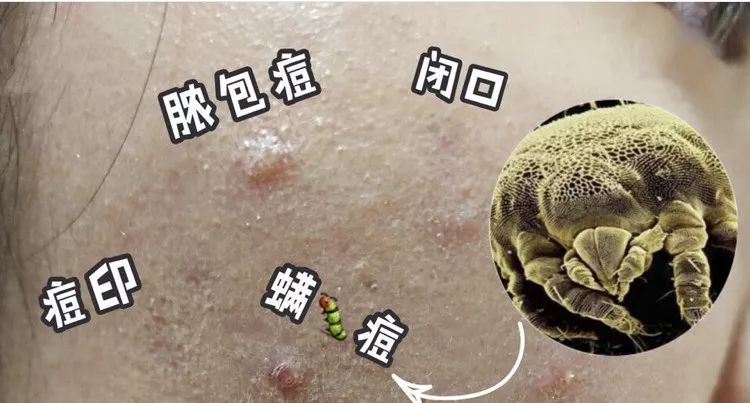 床上放个它让螨虫绝望让螨虫自杀比太阳暴晒强