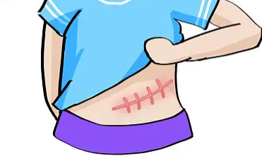 增生性瘢痕和瘢痕疙瘩的区别是什么?如何鉴别?