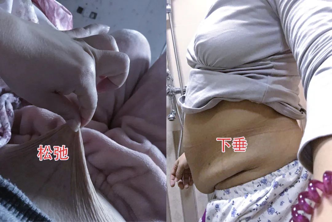 女性胃下垂的肚子图片图片