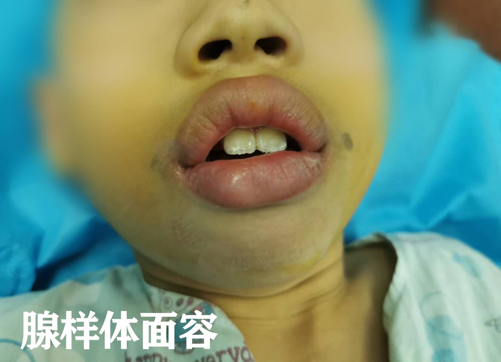 腺样体肥大其实就是吃多了,没那么复杂,教你一个方法,解决肥大  行医