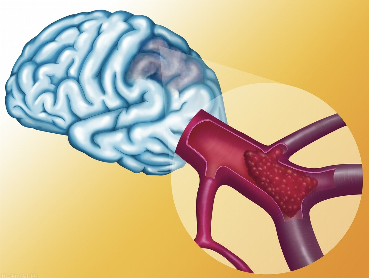 2药抗炎,抗动脉粥样硬化,改善微循环,增加供血供氧,心脑同治