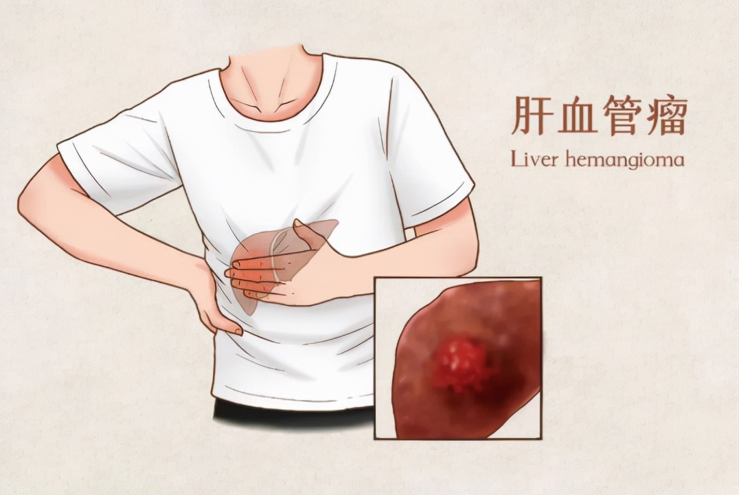 肝血管瘤危险吗图片