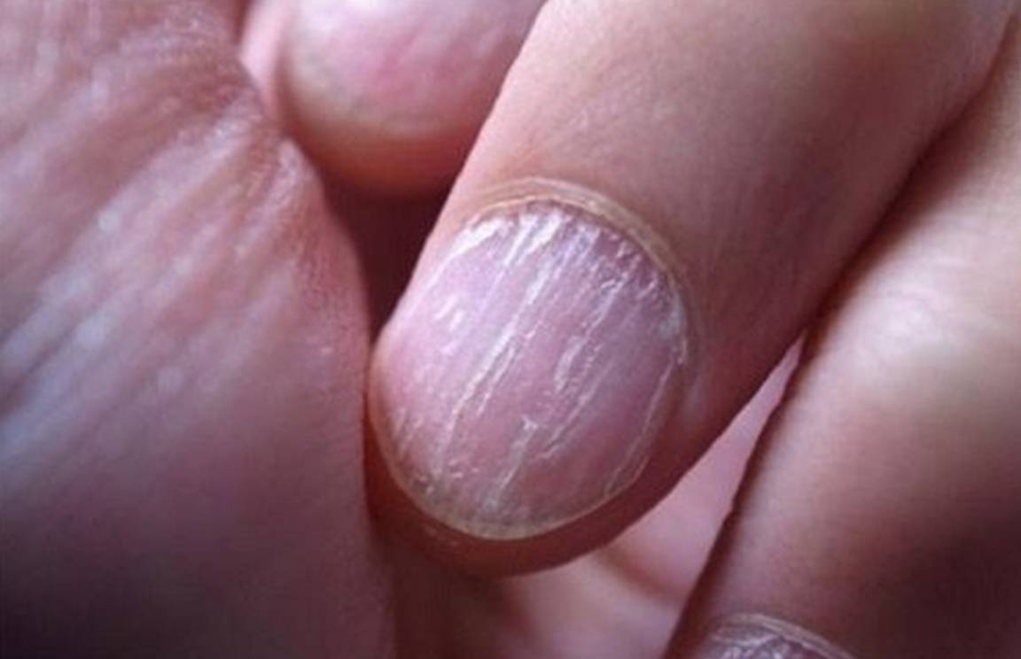 指甲常见病图片 竖纹图片