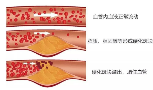 中国高血脂人群约1亿人,你在其中吗?