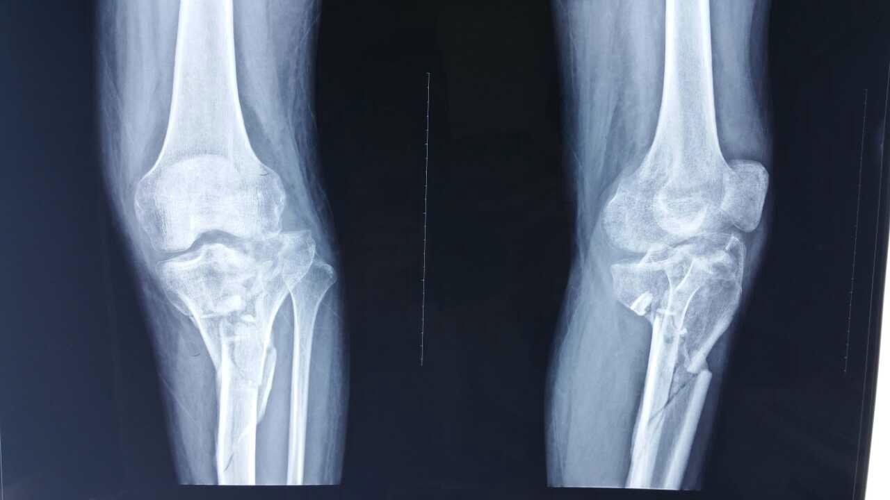 应力性骨折的患者,临床表现有疼痛和肿胀的表现,愈合较为缓慢