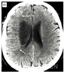 幕上大面积脑梗死的诊治