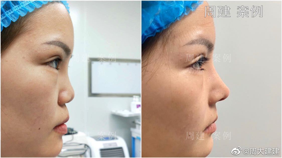 哑铃鼻基底,新术式不移位,郑州周建医生鼻整形专访