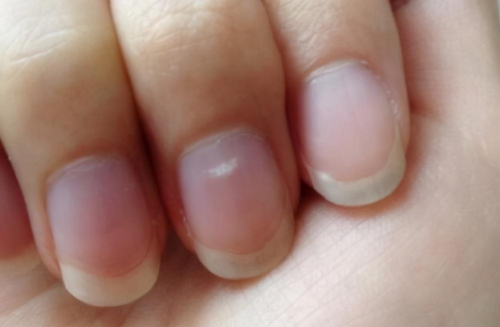 指甲盖上长白点是什么病?和白斑有关吗?