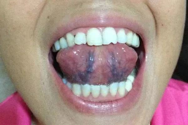 舌下黏膜皱襞图片