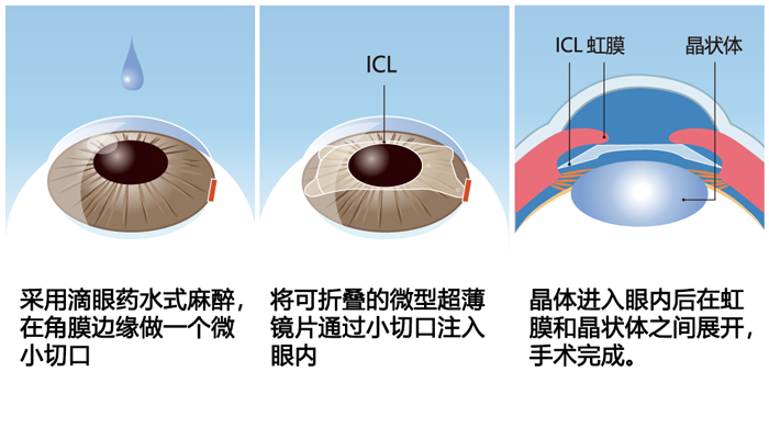 近视手术是如何矫正视力的?详解宁波太学眼科近视手术原理