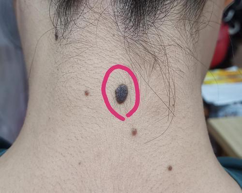 医生提醒:如果黑痣长在这3个部位,或要提高警惕