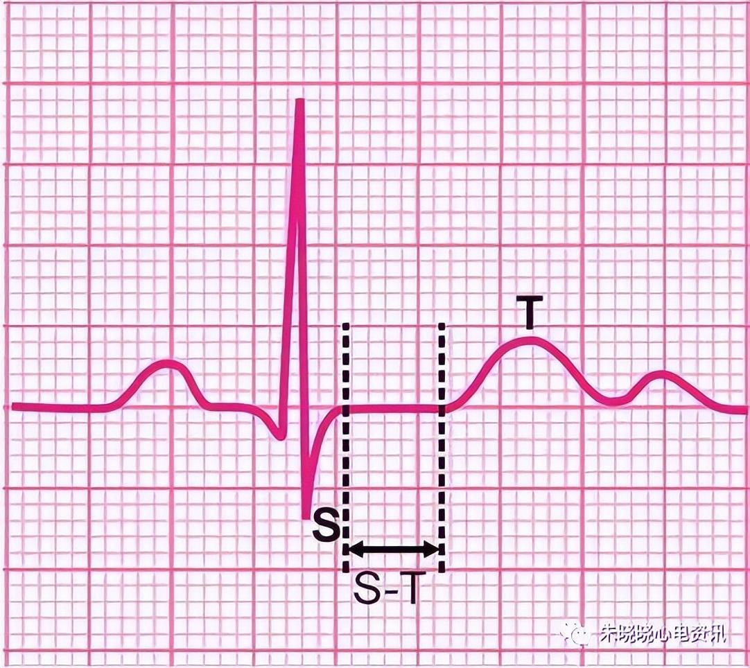 轻微心肌缺血的心电图图片