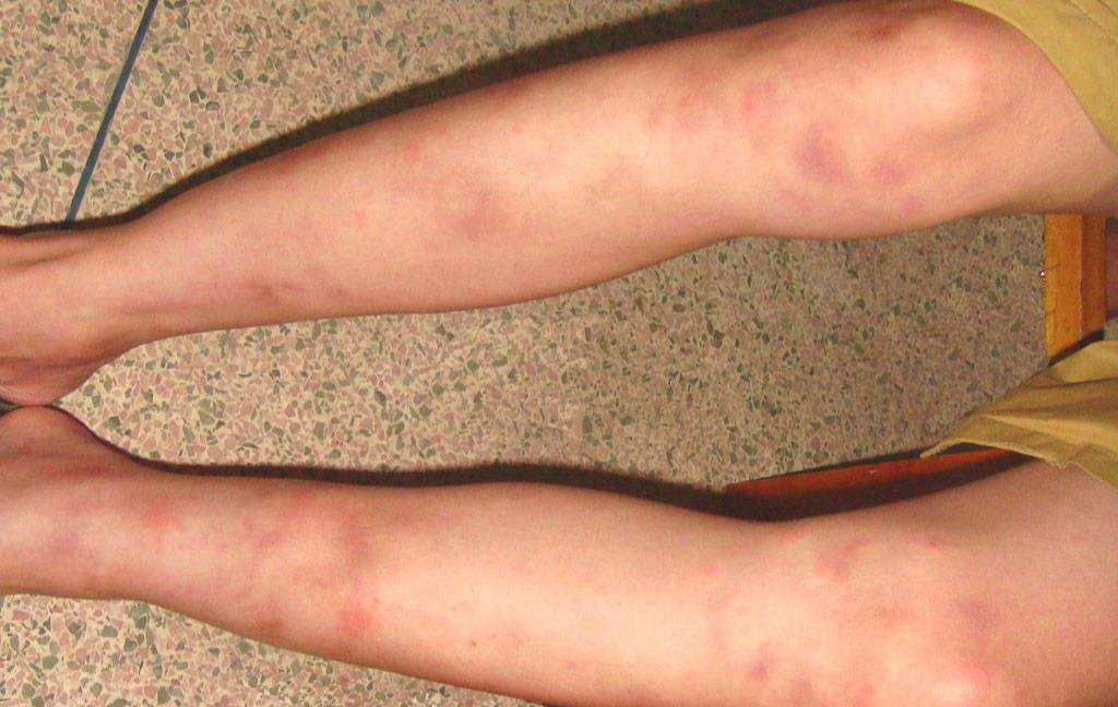 类风湿结节,主要是由于类风湿关节炎所致及类风湿结节病引起