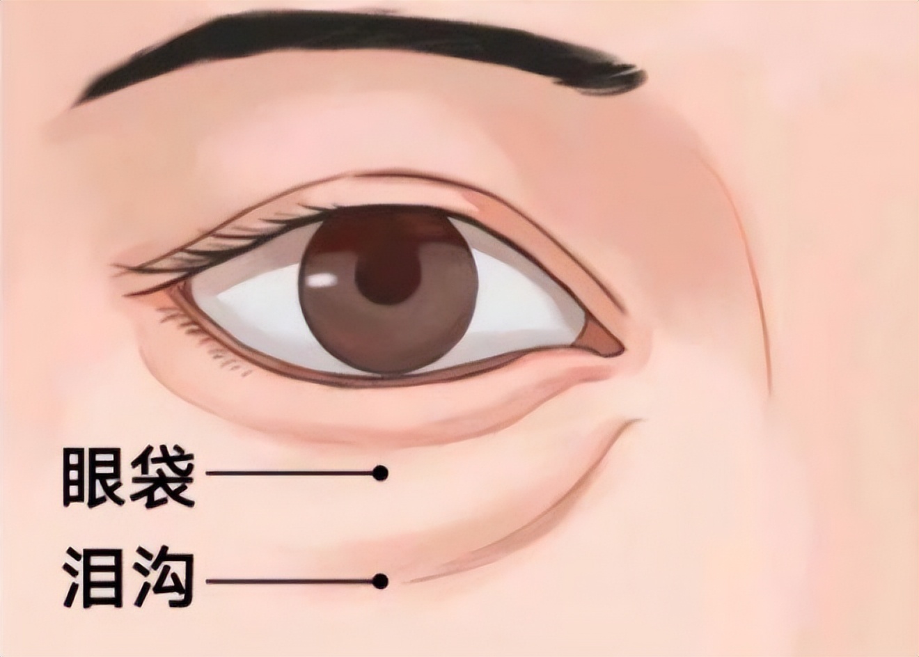 眼袋示意图图片