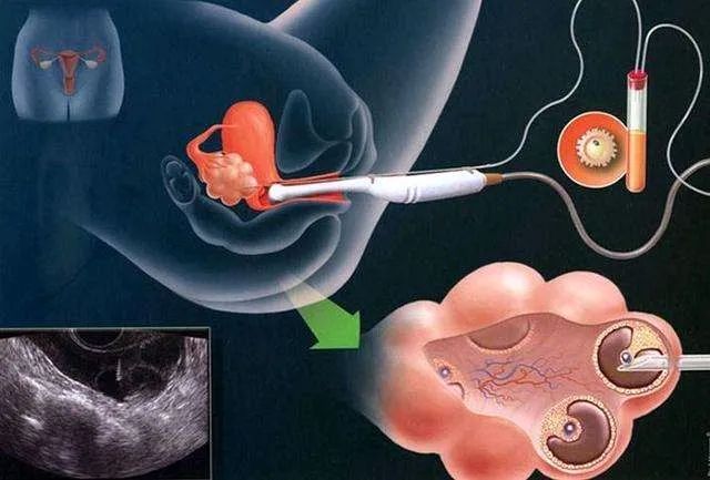 子宮內膜息肉一定要做宮腔鏡嗎?