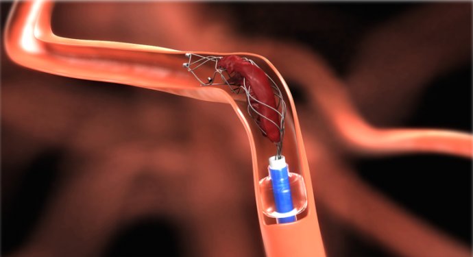 脑梗塞,中风偏瘫,右侧上下肢体完全动不了怎么办?