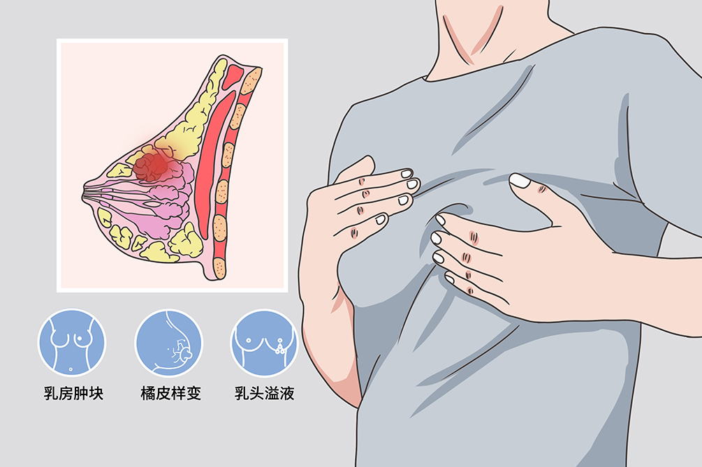 乳腺癌早期,身体或亮起5个"红灯,有1个也危险,早发现是关键