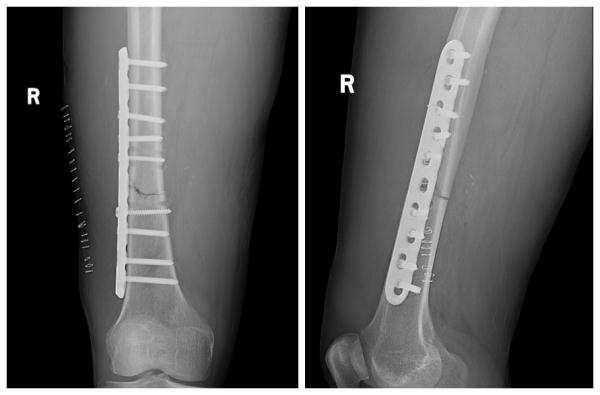 小切口治疗股骨干骨折,让意外伤无"微"不治