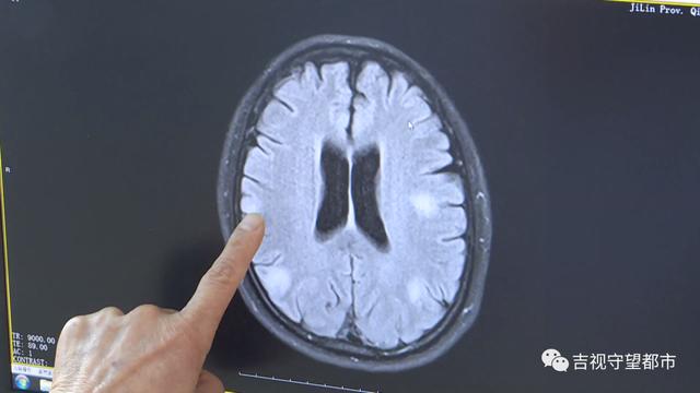 热点|女子一天吃一到两瓶辣酱还自行服胃药，两年半后大脑里“长毛”了