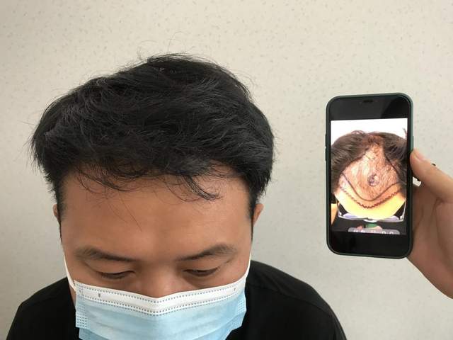 中植植发种植过程(中植植发医院在哪里)