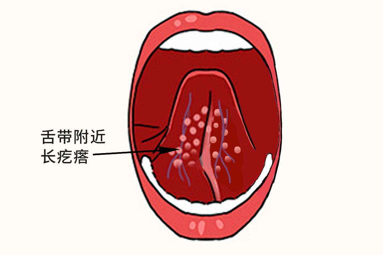 舌下乳头增生图片