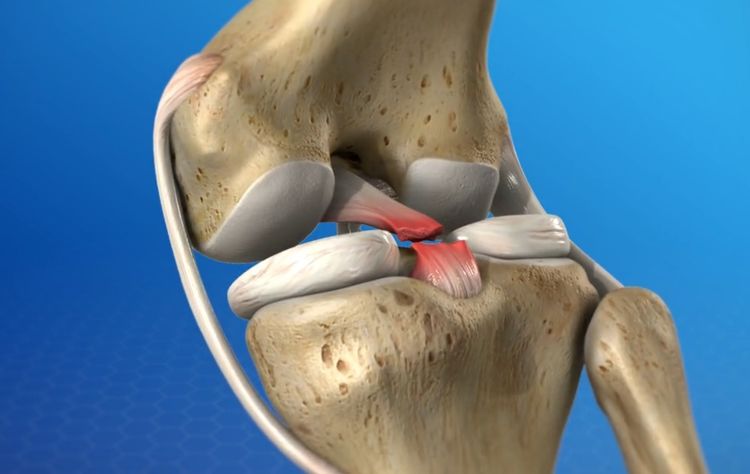 後交叉韌帶損傷posterior cruciate ligament injury