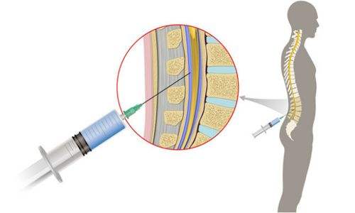 半麻和腰椎穿刺对腰椎的影响