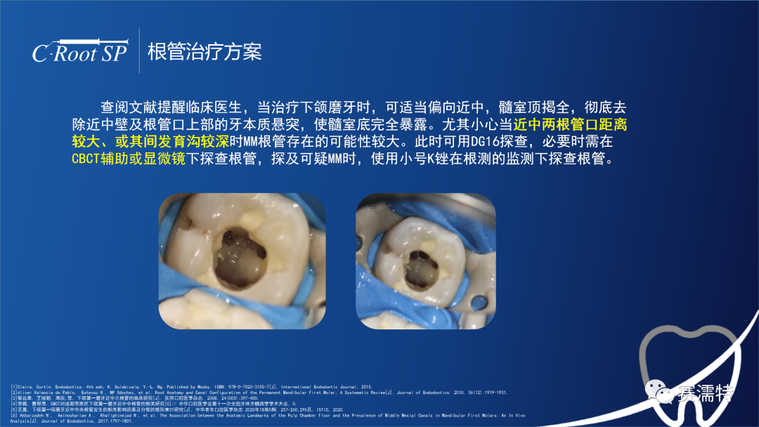 右下第一磨牙5根管再治疗病例
