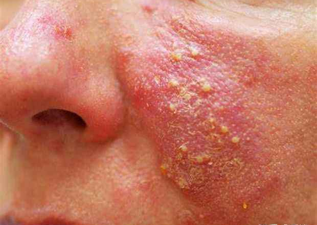 鲍恩病对患者身体会造成很大的损伤,患者全身各部位都会出现红斑