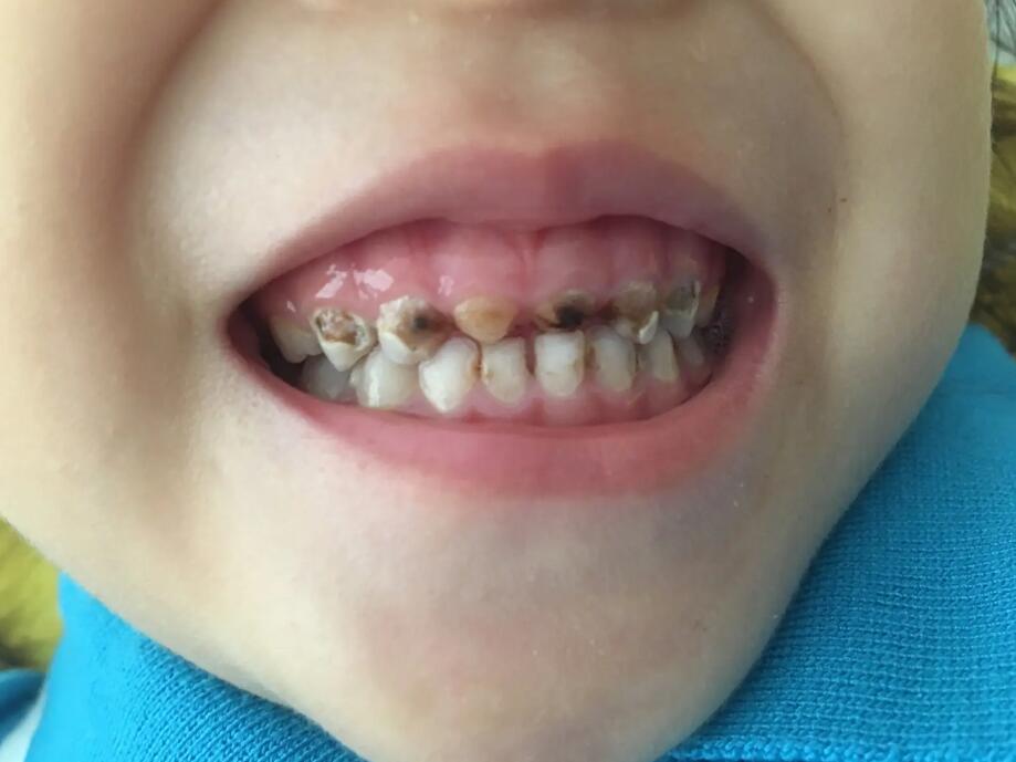 牙齿坏掉的儿童图片图片