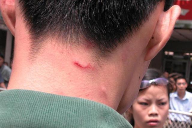脖子和腋下的"小肉粒"是什么东西?可以用手揪掉吗?看完要牢记