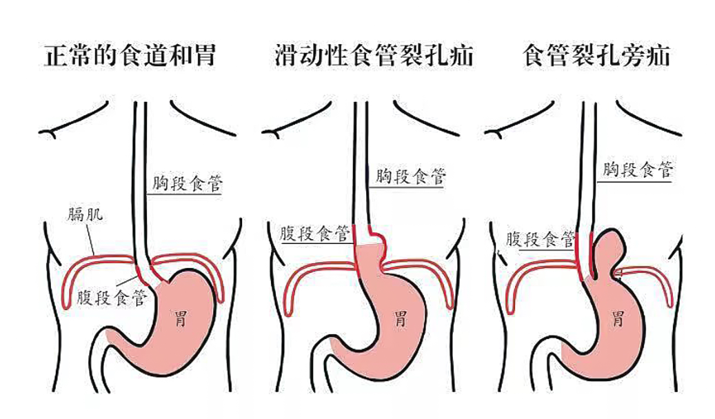 胃在胸骨的位置图片图片