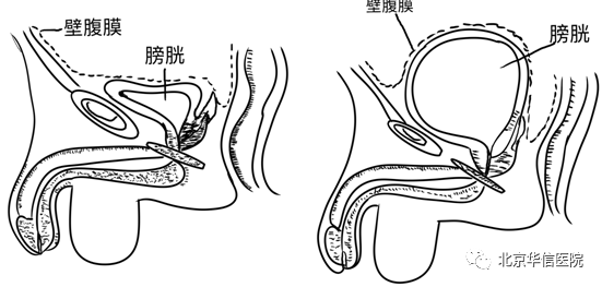 膀胱充盈图片图片