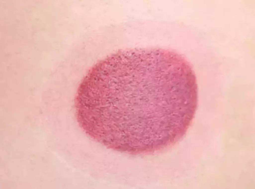 拔罐后,身上出现的瘀血是体内的毒素?多数人想错了