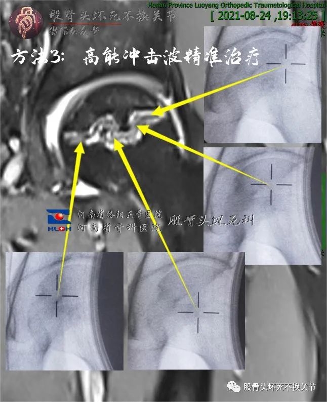 骨坏死之双线征,三线征