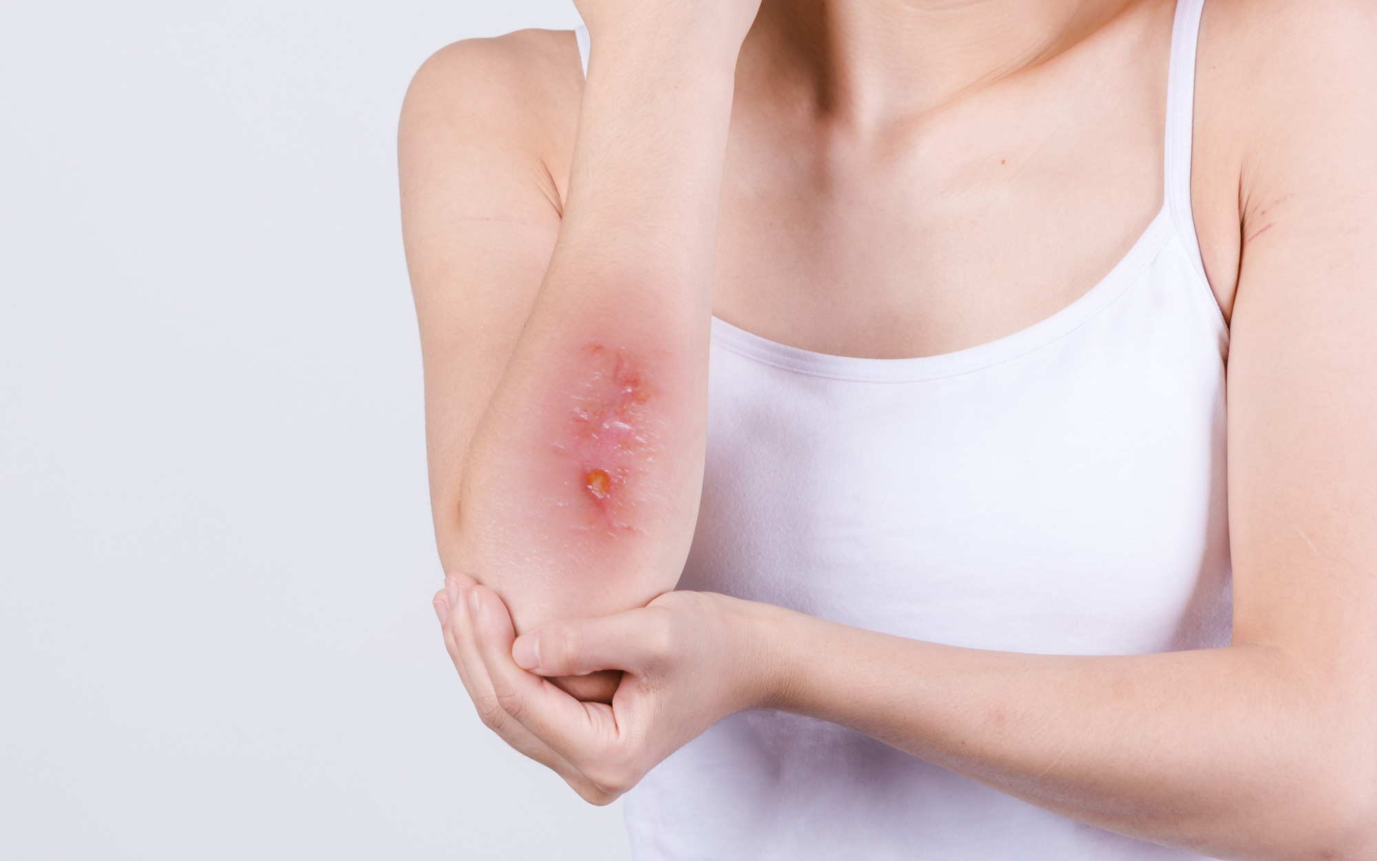 软下疳是一种性病,以抗菌药治疗为主,必要时需要清创,引流脓液