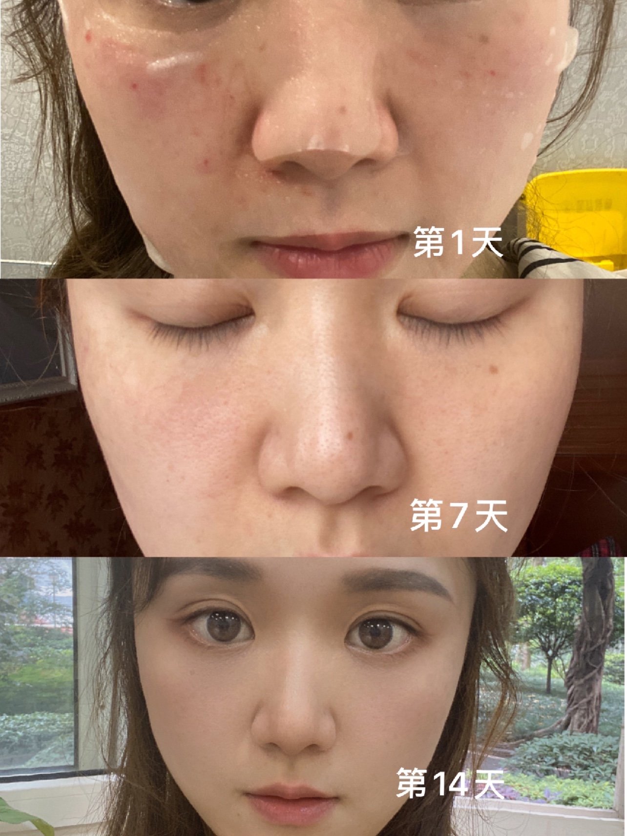 为什么有些人打完水光针会满脸红肿呢?