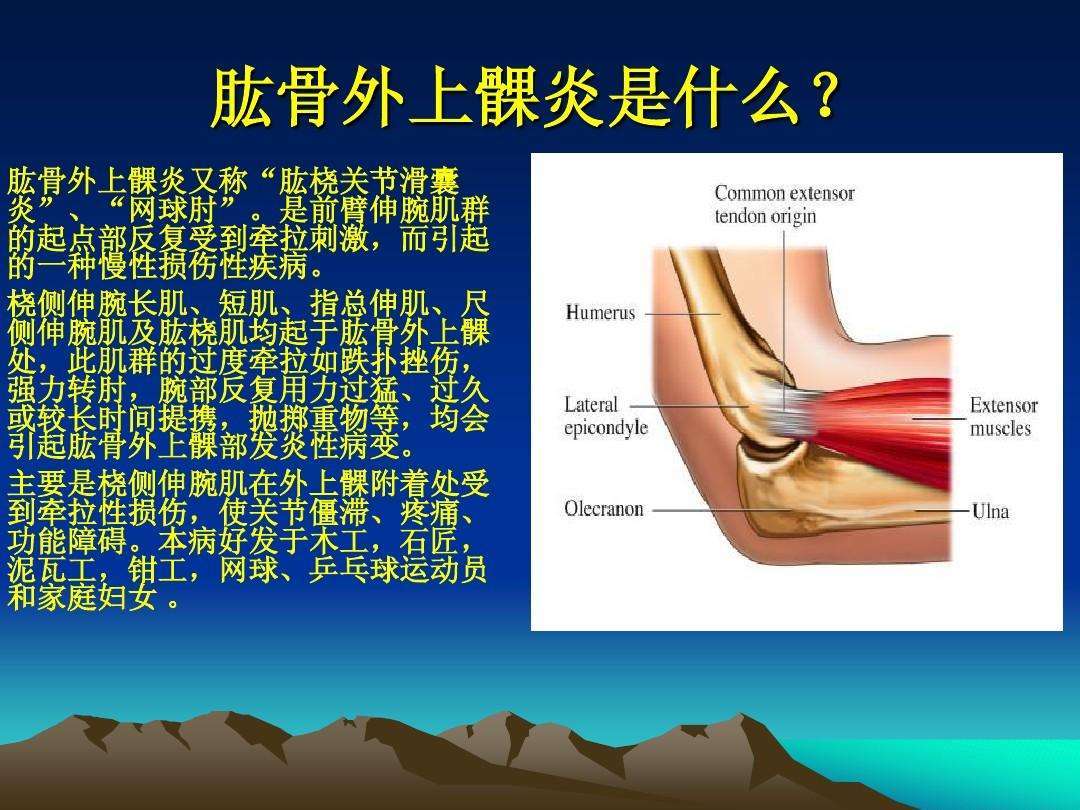 肱骨内上髁炎,病因尚未完全确定,与屈肌总腱反复紧张牵拉有关