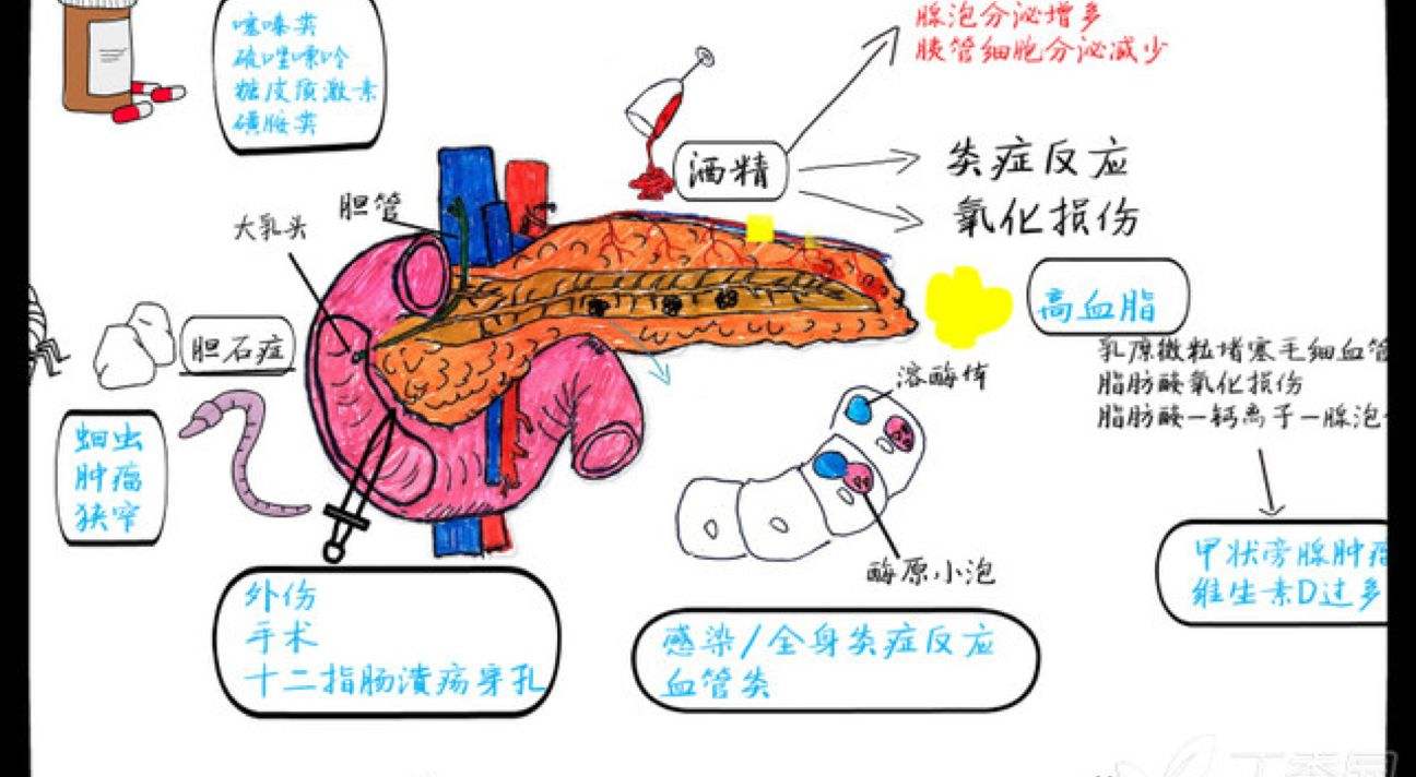 急性胰腺炎症状图片图片