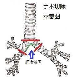 气管隆突成形术图片