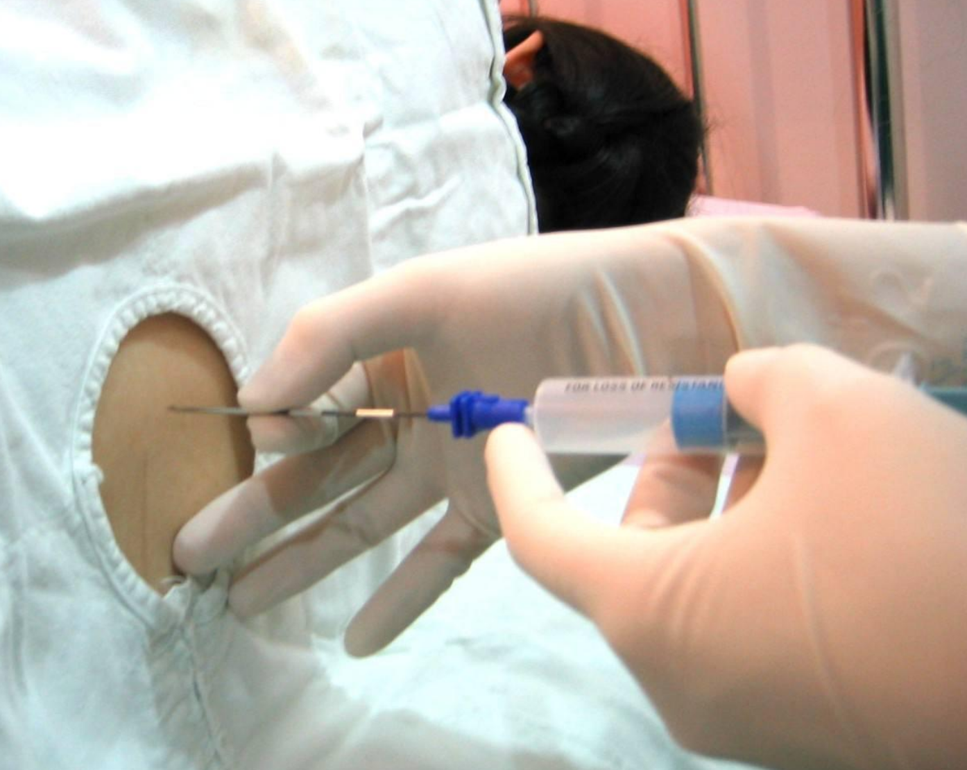 剖腹产有全麻不要紧?别小瞧剖腹产,10公分的腰椎穿刺针才是开始