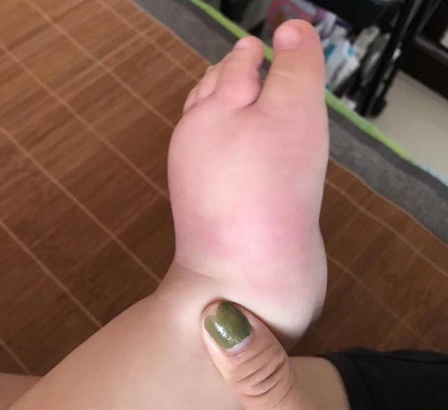 被蟑螂咬到的伤口怎么处理呢?