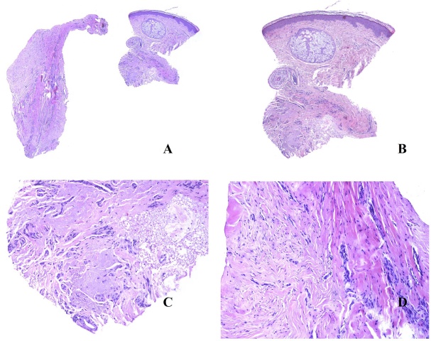 头颈部病理十大-促纤维增生性恶性黑色素瘤十大鉴别(二)