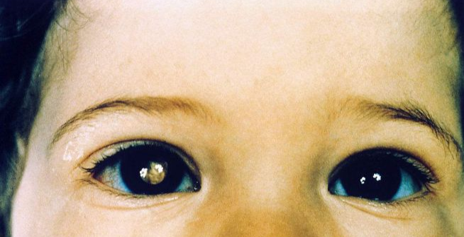 儿童视网膜母细胞瘤图片