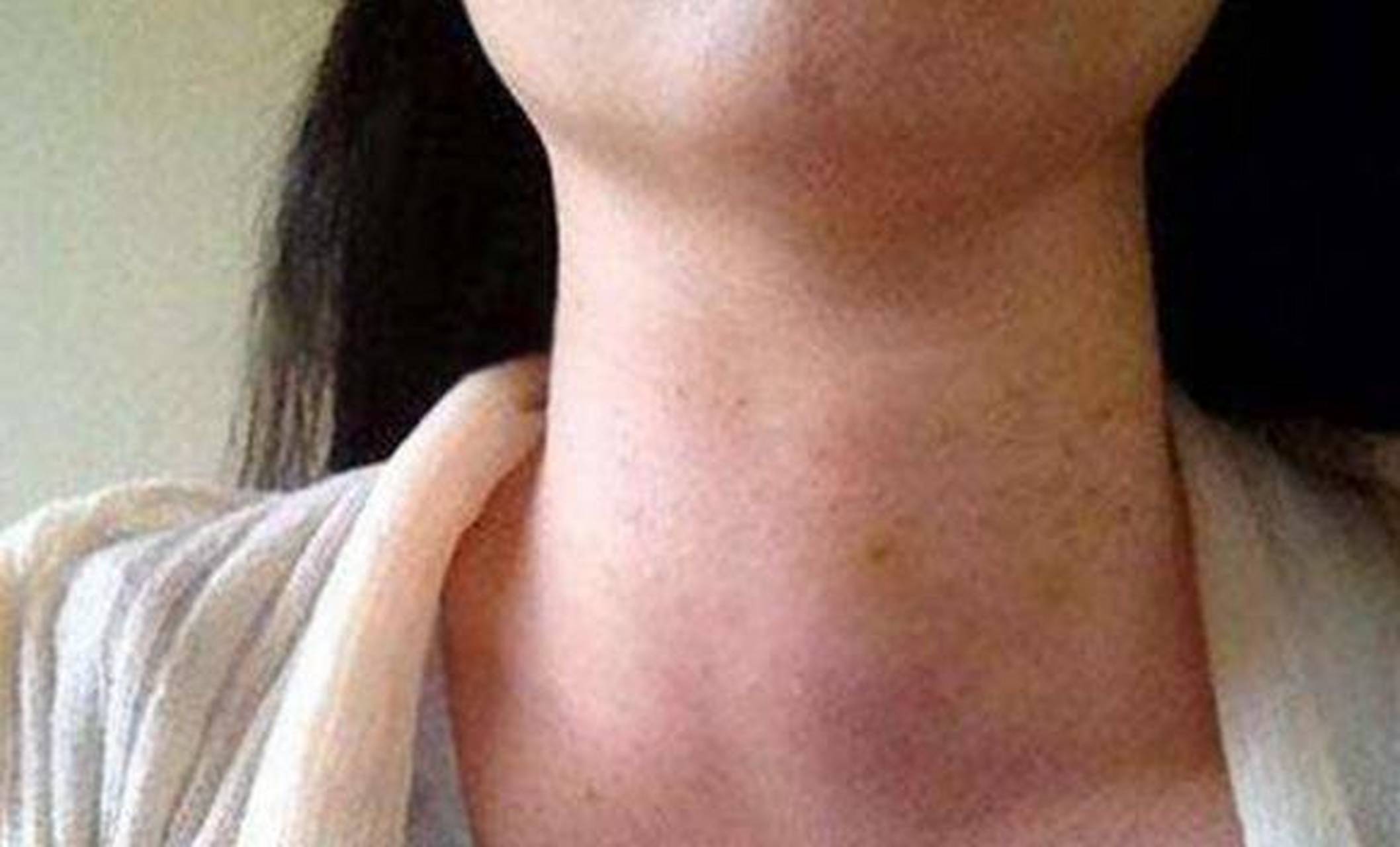 单纯性甲状腺肿曾经很大.这种症状表明病情较轻.