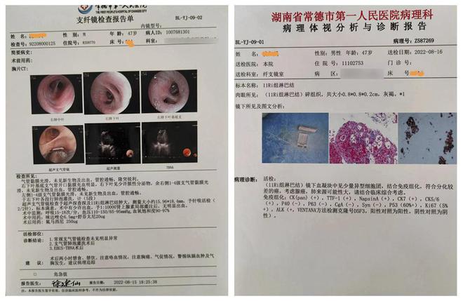 常德一医成功开展全市首例超声内镜引导下经支气管针吸活检术