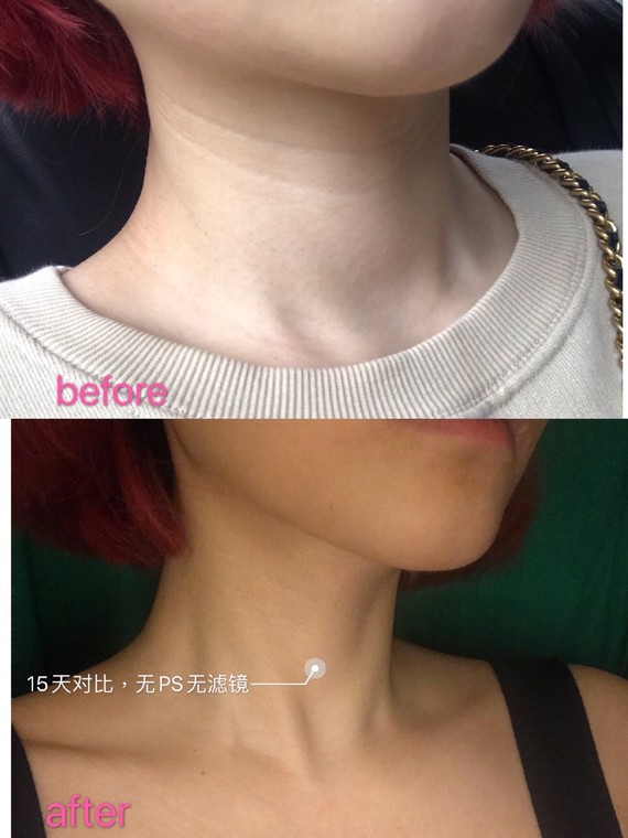 减轻颈纹常见的医美方式有哪些?